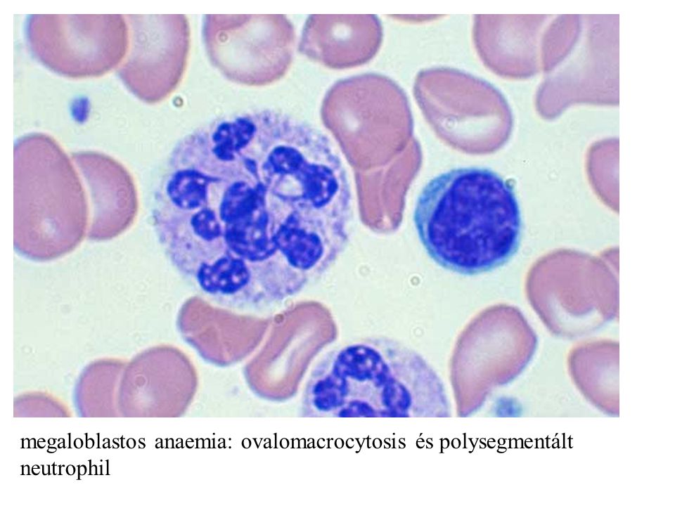 megaloblastos anaemia okai